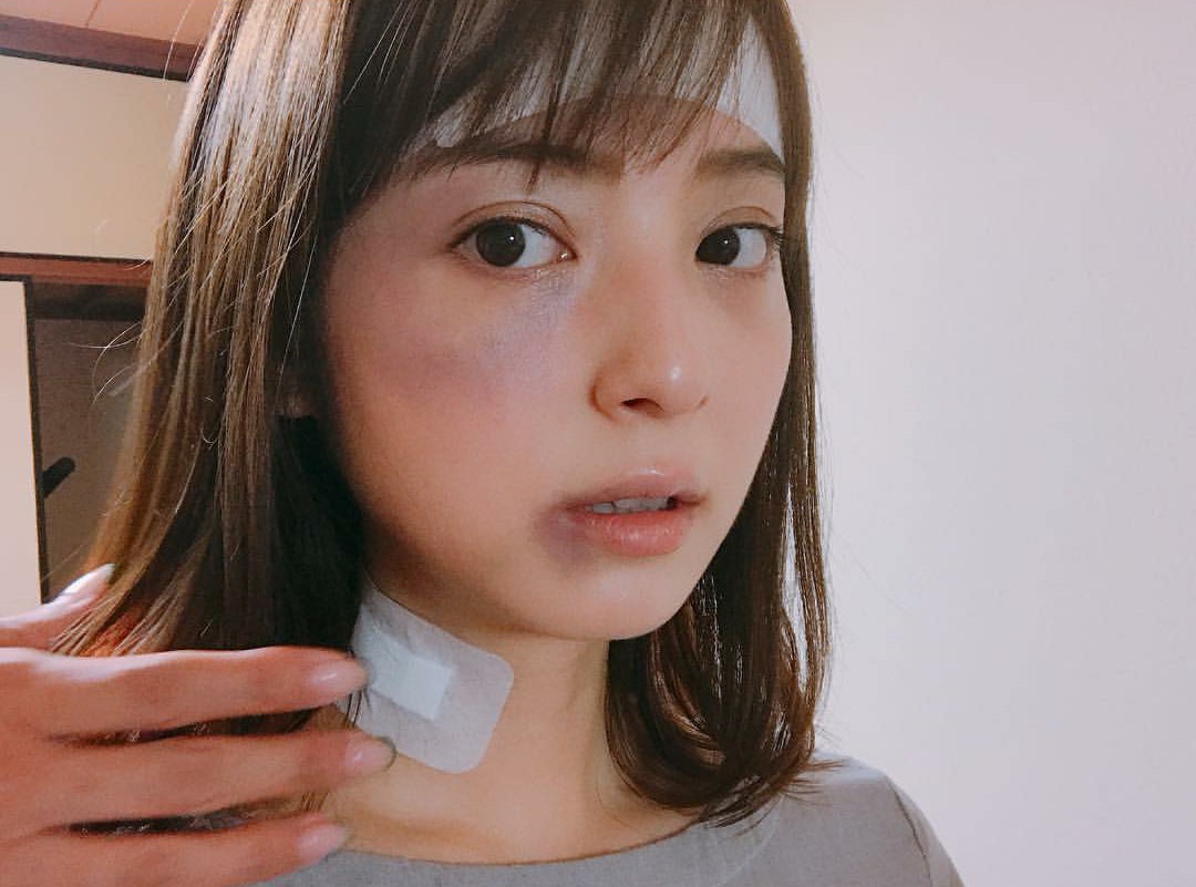 佐々木希の痛々しい姿にファン心配｢ビックリ...｣