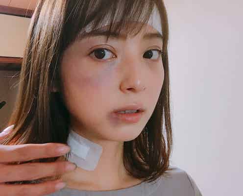 佐々木希の痛々しい姿にファン心配「ビックリ...」