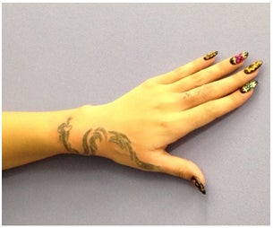 除去後／みぽちオフィシャルブログ（Ameba）より