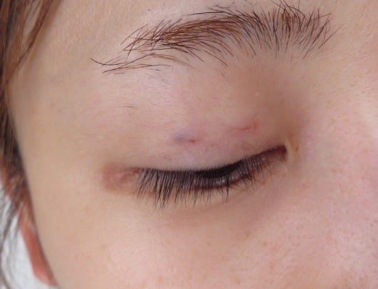 二重整形手術直後の桃の目／桃オフィシャルブログ（Ameba）より