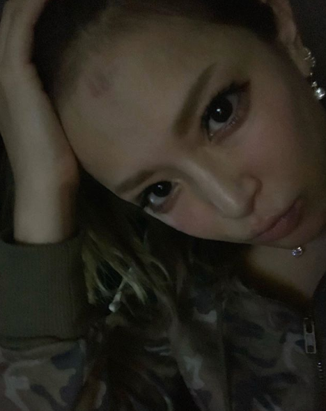 浜崎あゆみ おでこに火傷のあと残る写真公開に心配の声 痛そうー モデルプレス 浜崎あゆみ おでこに火傷のあと残る写真公開に心配の声 痛そうー モデルプレス