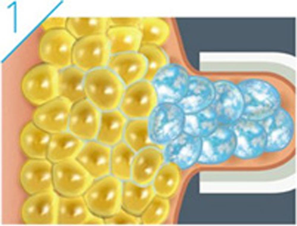 痩せたい部位にアプリケーターを装着し、温度をコントロールしながら一定時間冷却します。(提供画像)