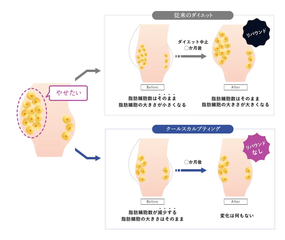 クールスカルプティング（クルスカ）のメカニズム 