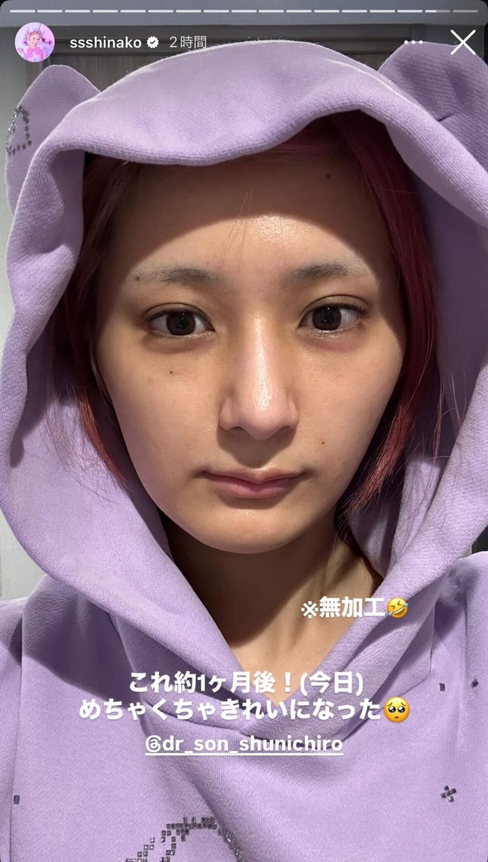 術後1ヶ月後の姿/しなこInstagramストーリーズより