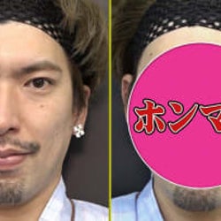 りんたろー。、オカリナ、磯野貴理子が 最新美容整形法「ハイフ」に挑戦!その効果は?
