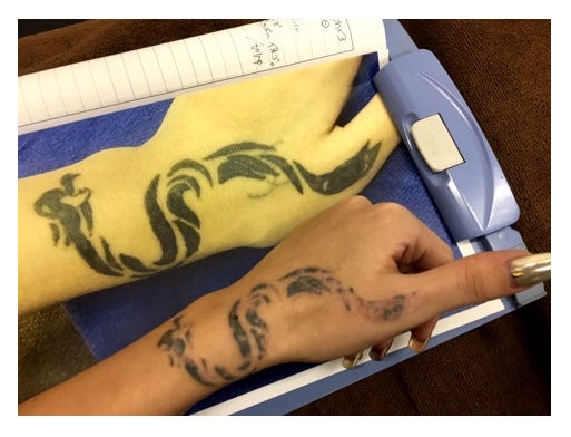 除去治療開始前と今回の除去前のビフォーアフター写真、刺青がかなり薄く/みぽちオフィシャルブログ(Ameba)より