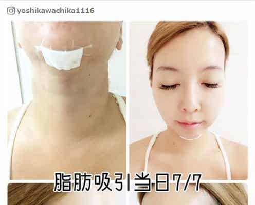 脂肪吸引施術の双子モデル・吉川ちか、経過を報告「めっちゃ感動と嬉しさやばい」
