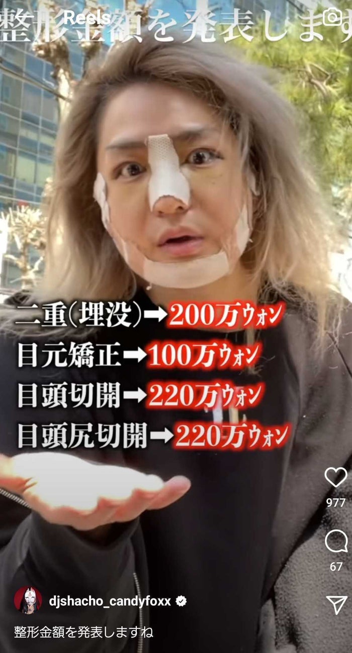 総額250万整形 のdj社長 術後1ヵ月経過報告 もっとイケメンになった 可愛い と反響 モデルプレス 総額250万整形 のdj社長 術後1ヵ月経過報告 もっとイケメンになった 可愛い と反響 モデルプレス