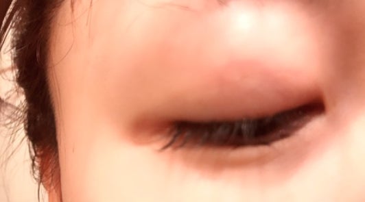 二重整形手術後半年の桃の目／桃オフィシャルブログ（Ameba）より