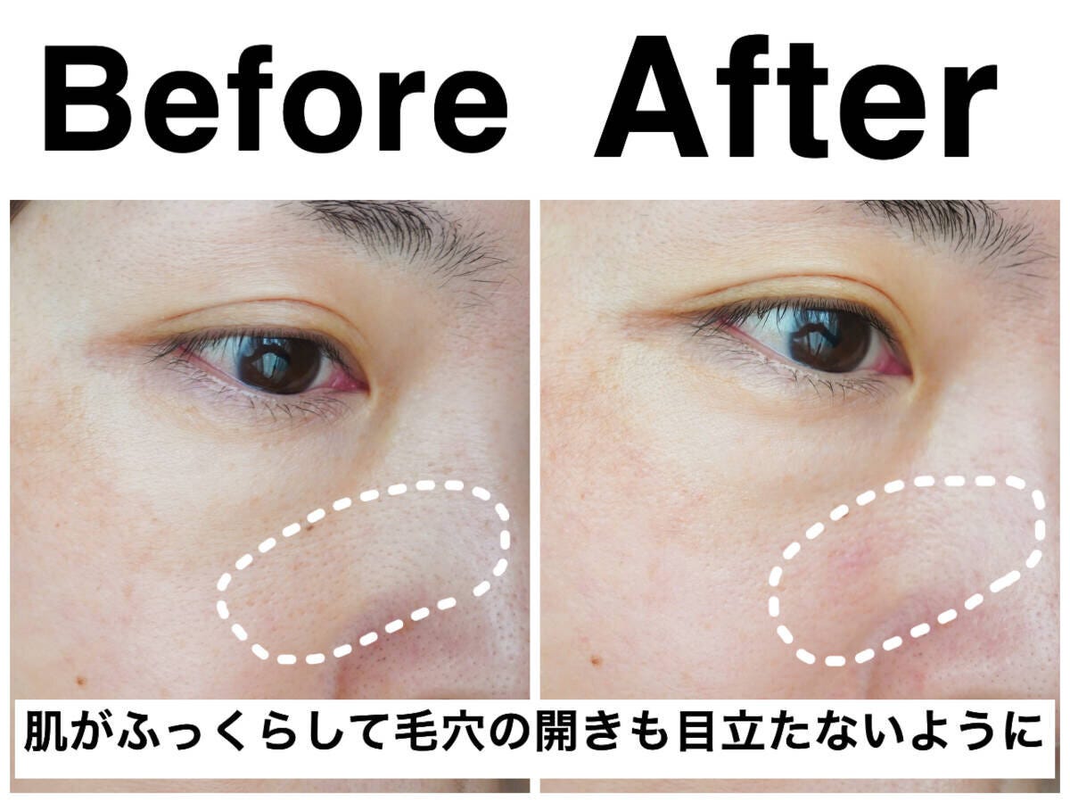 使用前後の頬の毛穴を比較したビフォーアフター画像