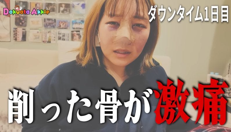71万人YouTuber、鼻整形手術を公表「人生一回しかない」術後2ヶ月の記録