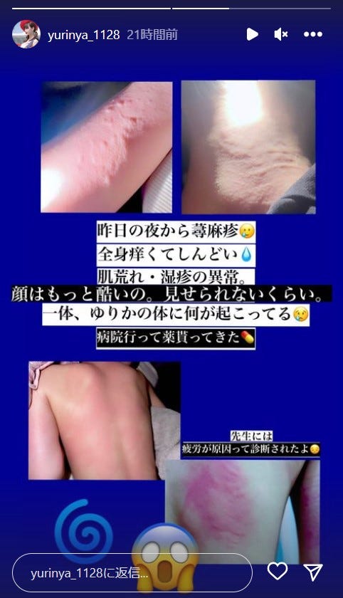 蕁麻疹が出ているゆりにゃ/ゆりにゃInstagramストーリーズより