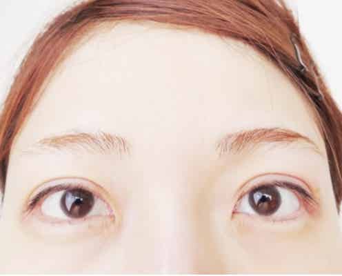 「あいのり」桃、整形したての目を公開