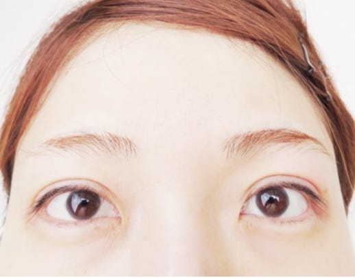 二重整形手術直後の桃の目/桃オフィシャルブログ(Ameba)より