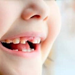 1歳ですべての歯の虫歯と糖尿病を予告された娘【ママの体験談】