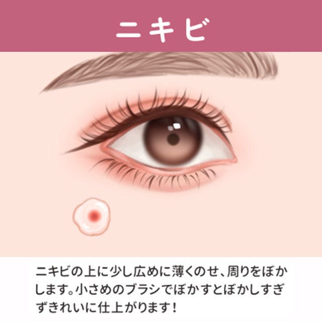 ニキビ