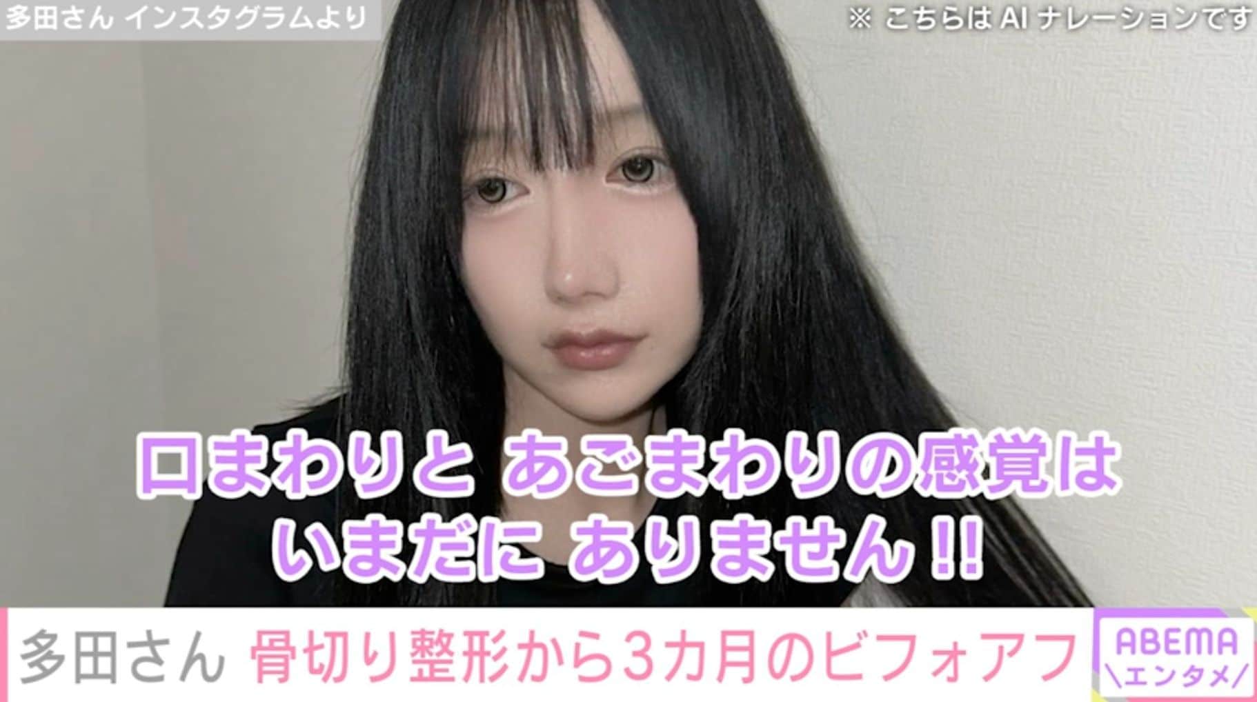『月曜から夜ふかし』フェフ姉さんの友人・多田さん、両あご&輪郭骨切り整形から3カ月後の姿を公開「感覚はいまだにありません」