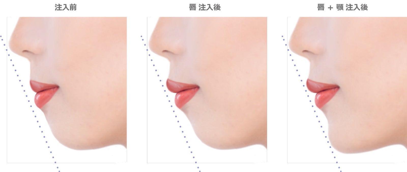 ヒアルロン酸注入治療の変化（提供素材）