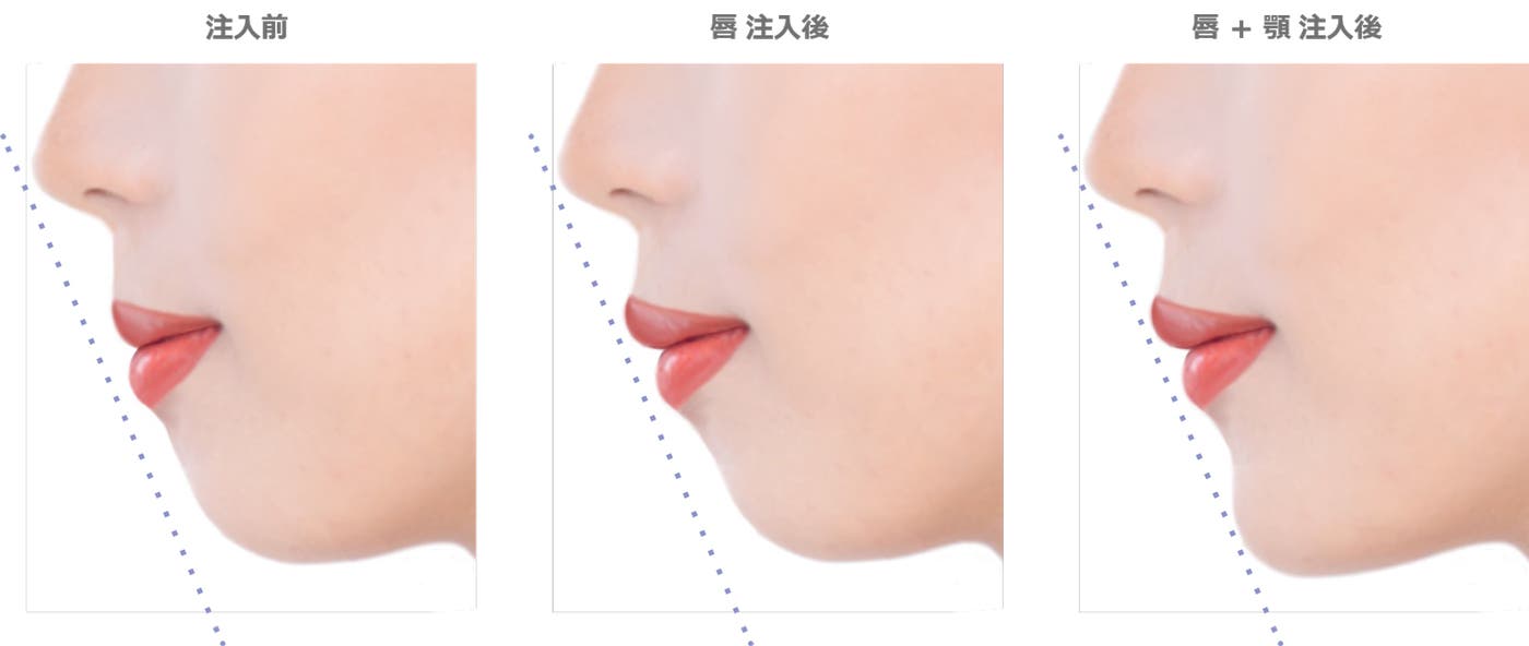 ヒアルロン酸注入治療の変化(提供素材)