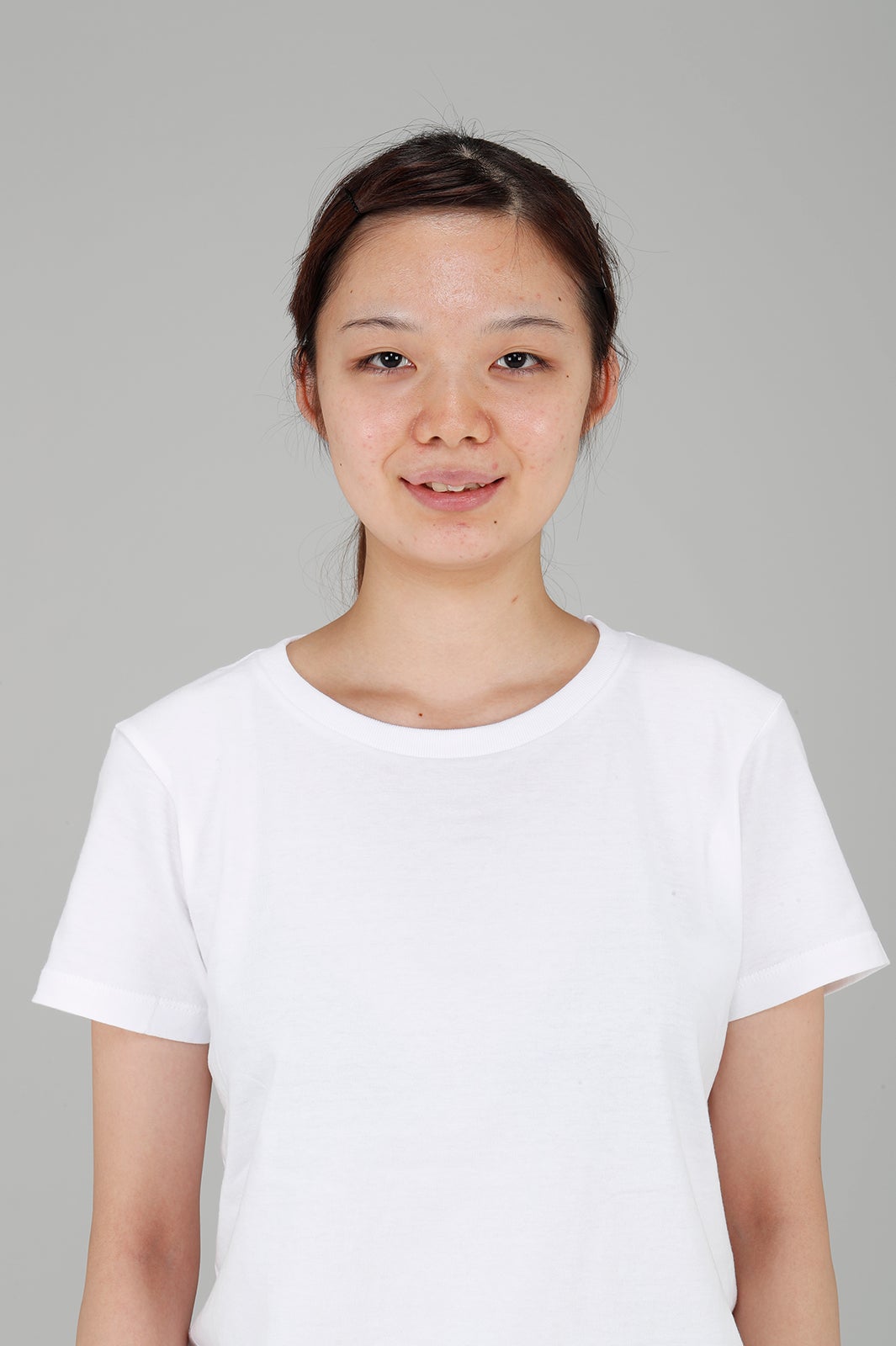 加藤叶華さん／整形前 （提供写真）