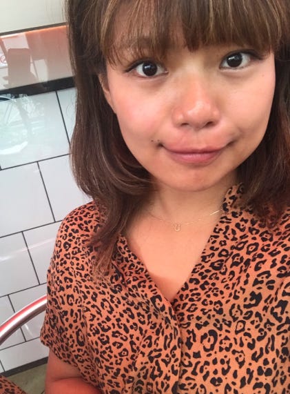 整形2日目/クロオフィシャルブログ(Ameba)より