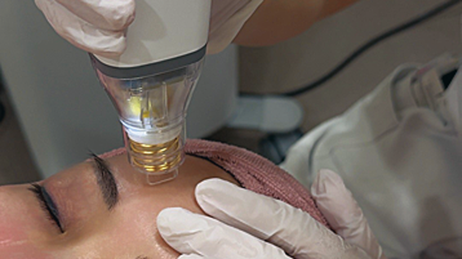 【美容医療】ニキビあとに悩む方必見！初心者さんにおすすめの「ポテンツァ＆エレクトロポーション」