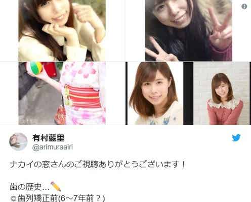 有村藍里、矯正から歯茎カットまで「長い戦い」ビフォーアフター写真公開 治療決意までの思い