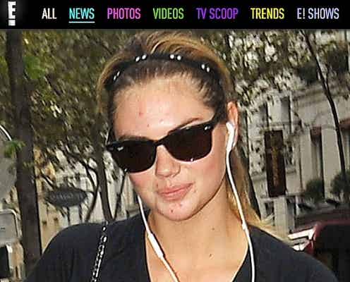 青春ニキビあり!セクシーモデル、ケイト・アプトンのスッピン