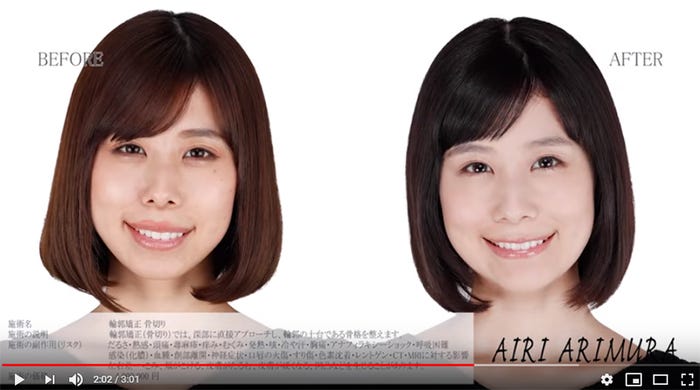 整形公表の有村藍里 施術金額は ビフォー アフターを動画で公開 モデルプレス 整形公表の有村藍里 施術金額は ビフォー アフターを動画で公開 モデルプレス