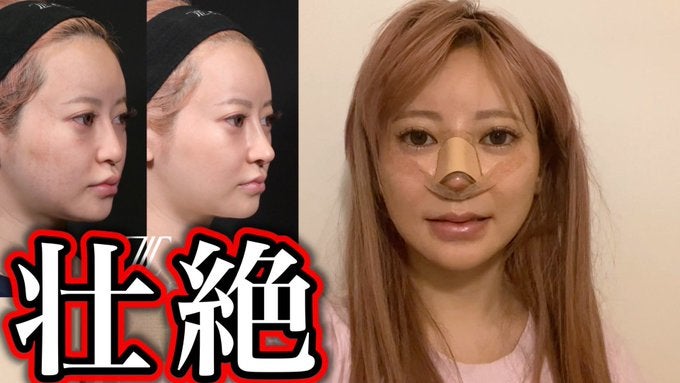 ヘラヘラ三銃士まりな、鼻を再々整形 手術までの過程・術後の様子公開